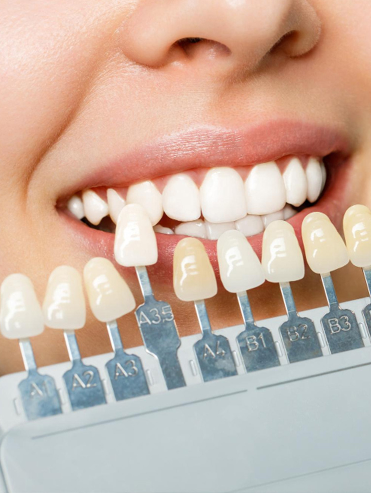 Laminate Veneer in Turkey