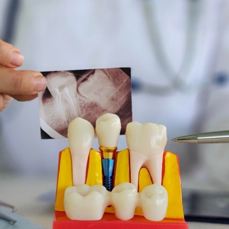 All on 6 Dental Implants