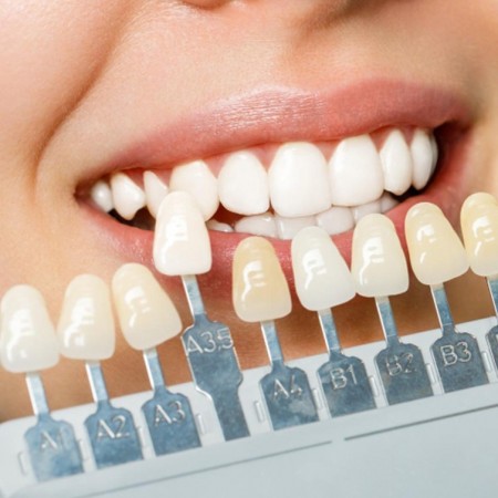 Laminate Veneer in Turkey