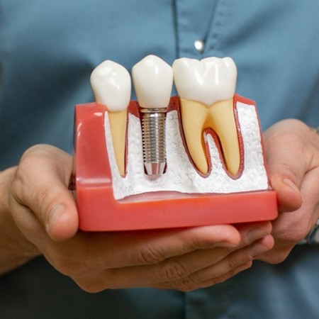 Dental Implants Turkey