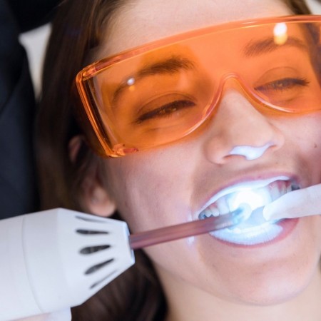 Teeth Whitening